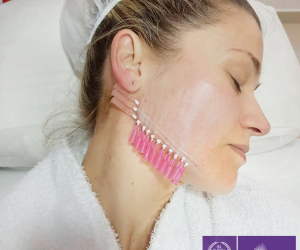 Hilos tensores el tratamiento para rejuvenecimiento facial  sin cirugía que ofrece Presenza